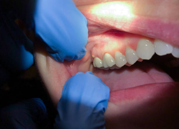 Best Emergency Treatment for Dental Infections or Abscesses in New Paris, OH