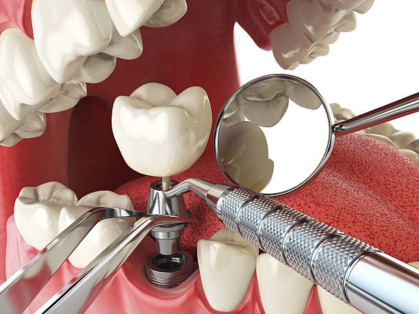 Best Emergency Tooth Extraction in New Paris, OH